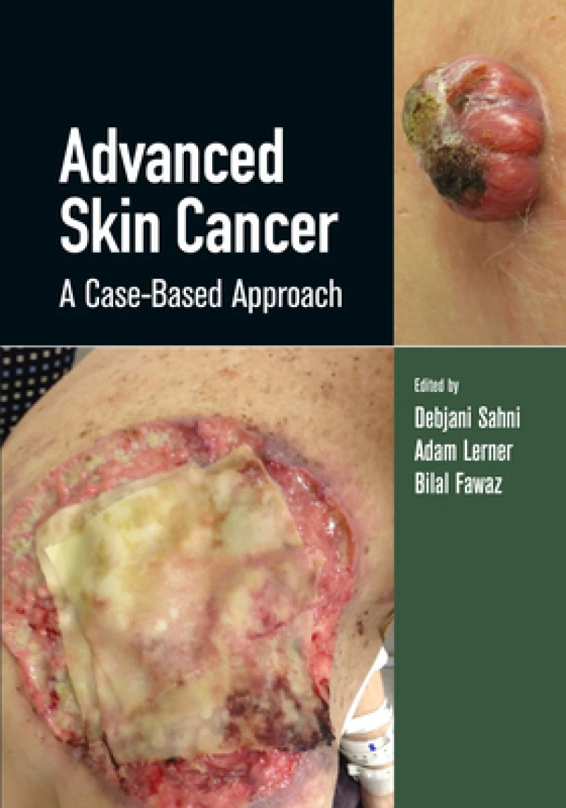 Advanced Skin Cancer