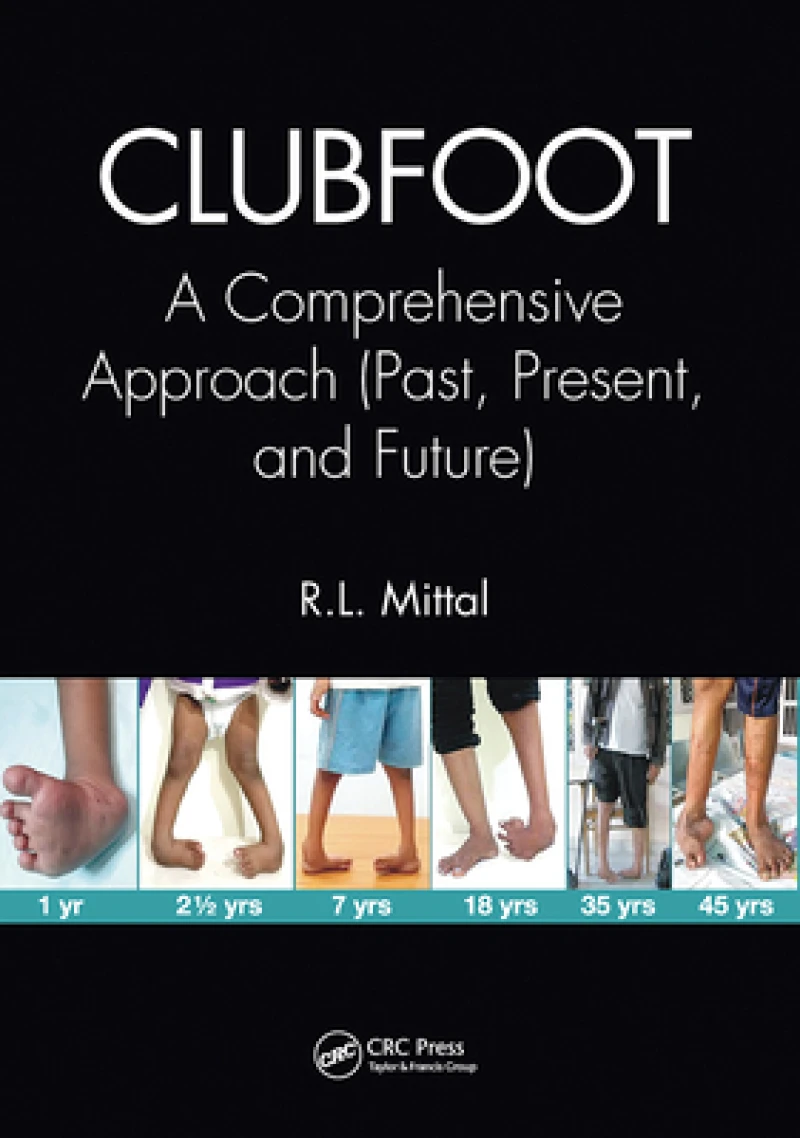 Clubfoot