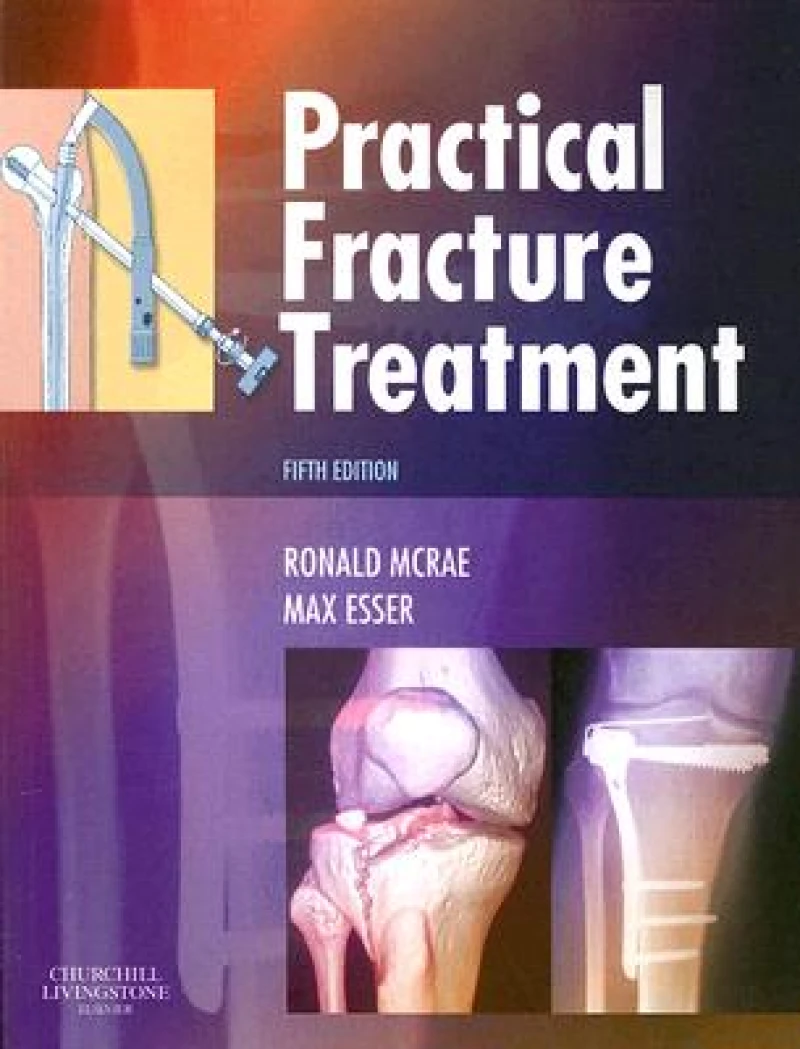 Practical Fracture Treatment