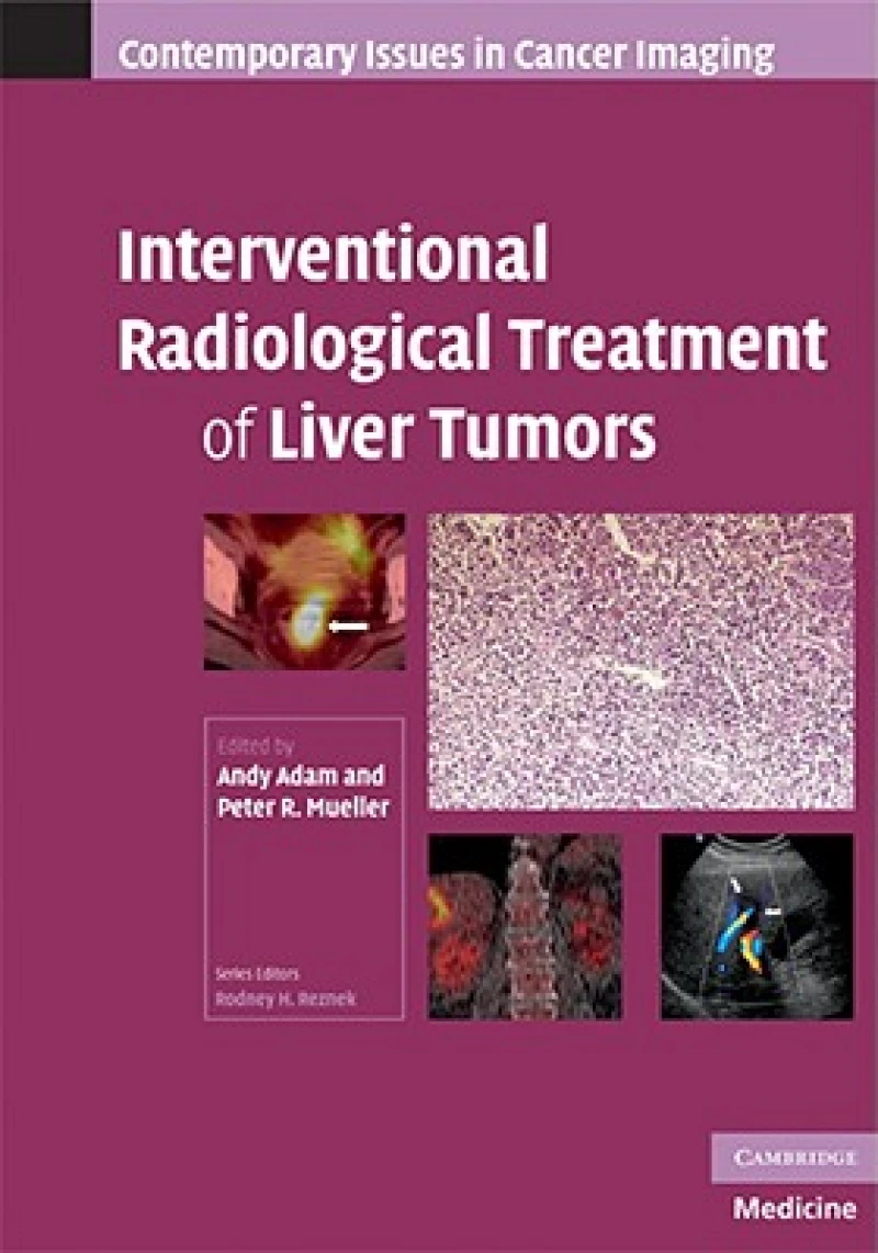 Interventional Radiological Treatment of Liver Tumors