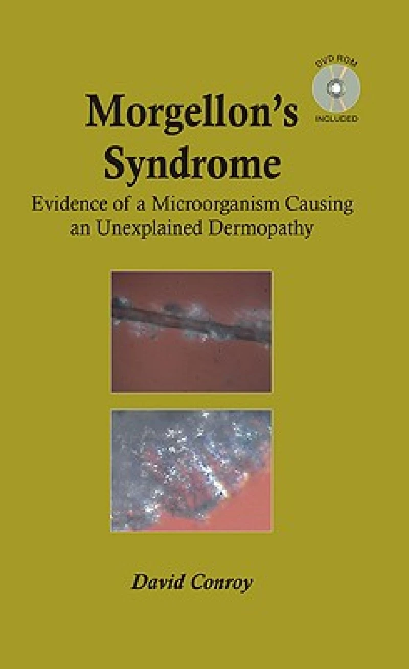 Morgellon''s Syndrome
