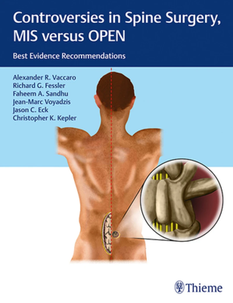 Controversies in Spine Surgery, MIS Versus OPEN