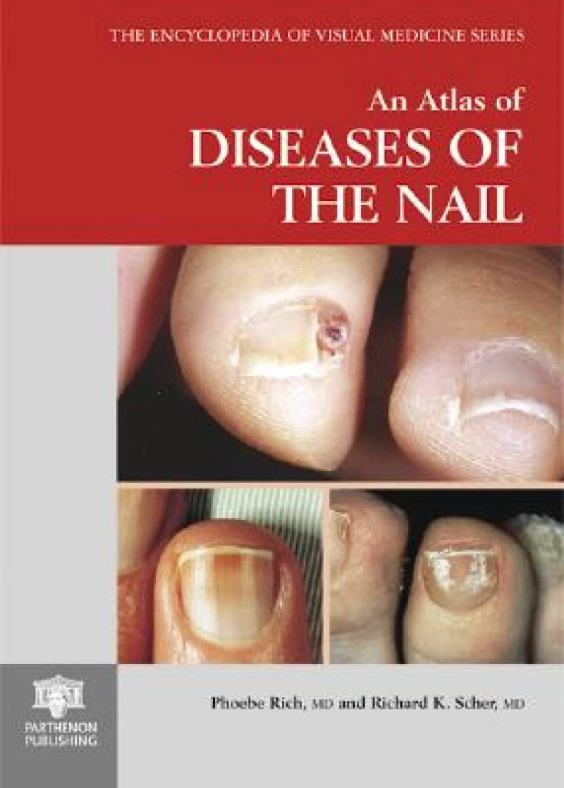 An Atlas of Diseases of the Nail