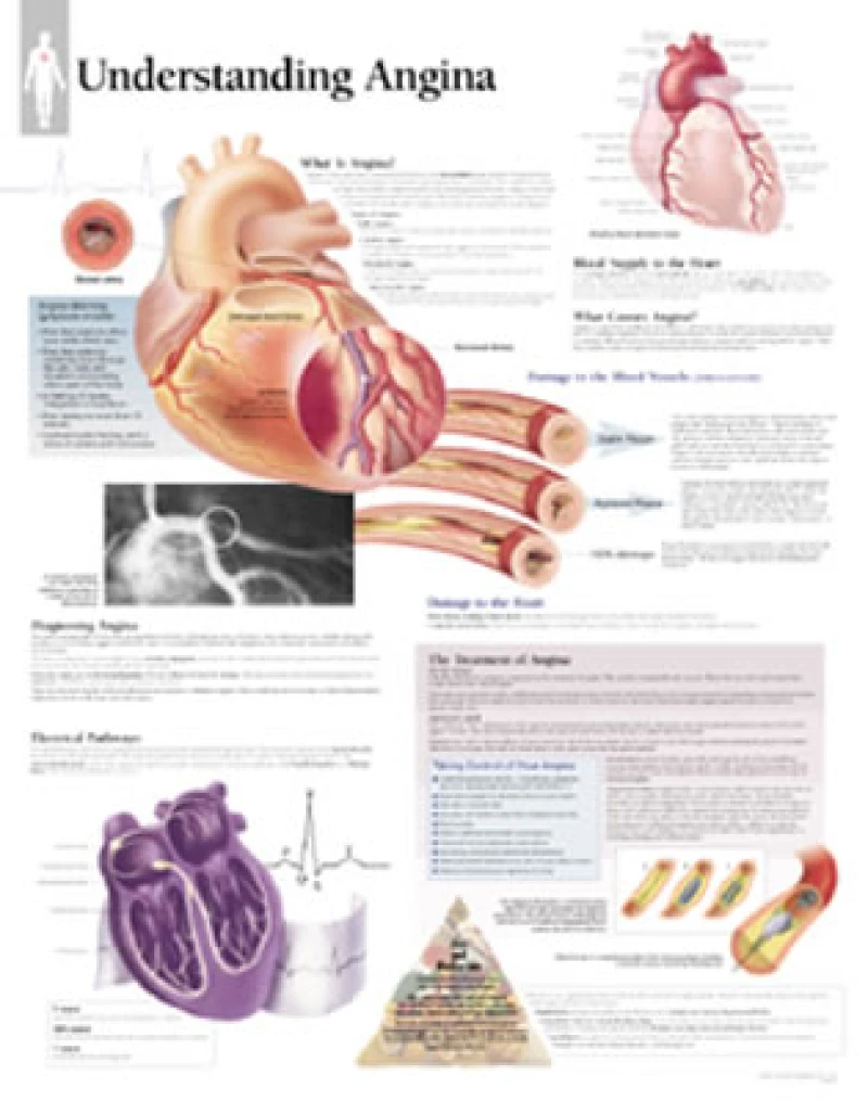 Understanding Angina Laminated Poster