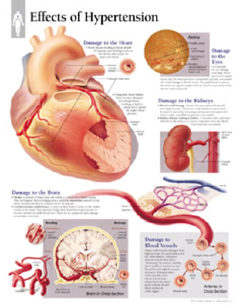 Effects of Hypertension Laminated Poster