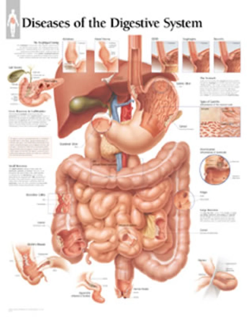 Diseases of the Digestive System Paper Poster