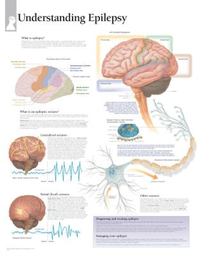 Understanding Epilepsy Paper Poster