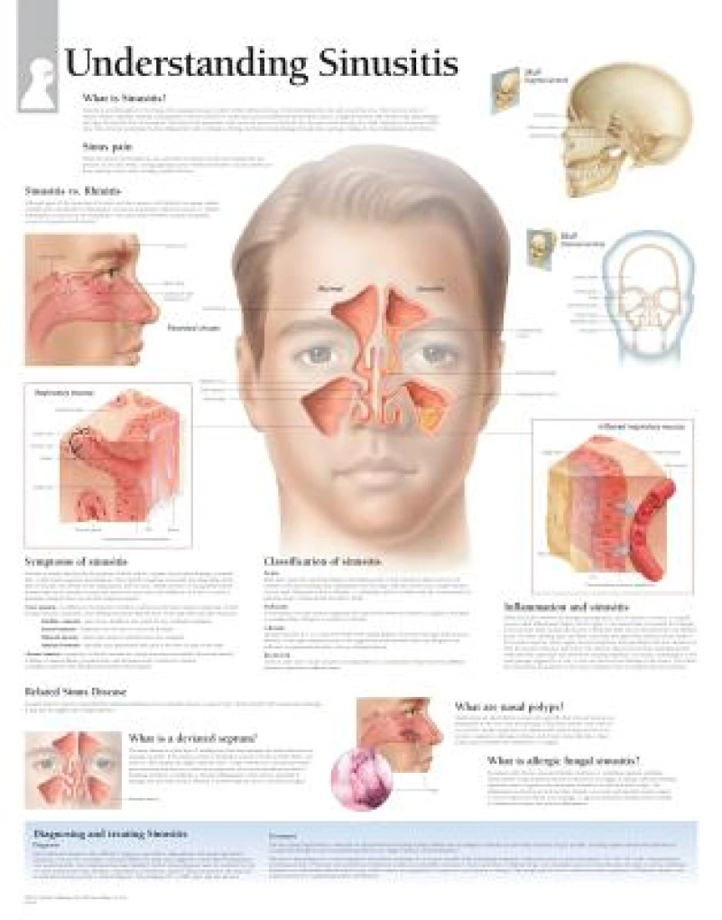Understanding Sinusitis Paper Poster